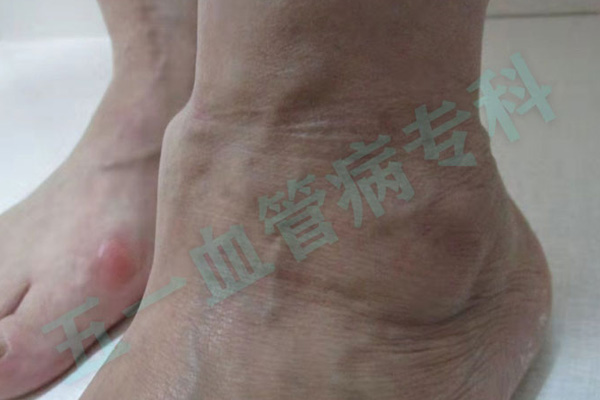 静脉曲张和动脉硬化有什么区别？沈阳静脉曲张专科五一静脉曲张专科将对这两种疾病进行比较和分析！
