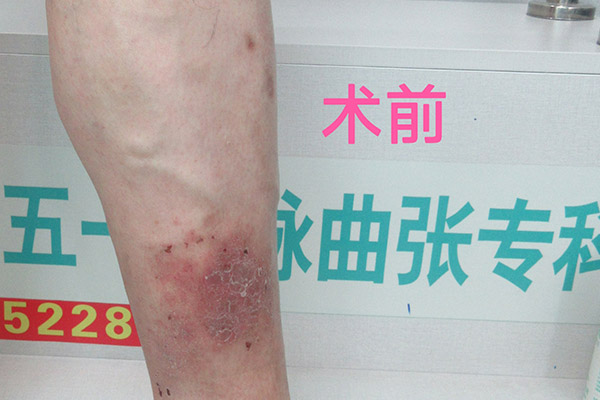 告别“青筋盘踞”，拥抱健康双腿：大连静脉曲张专科医院的微创新选择