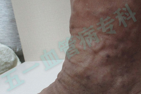 腿部血管凸起怎么办?了解沈阳下肢静脉曲张的常见症状 腿部血管凸起怎么办?了解沈阳下肢静脉曲张的常见症状