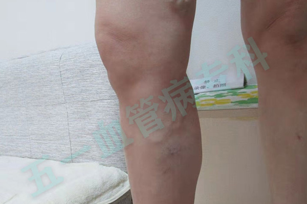 揭秘下肢静脉曲张的诊断：沈阳专科医院如何精准“透视”静脉功能